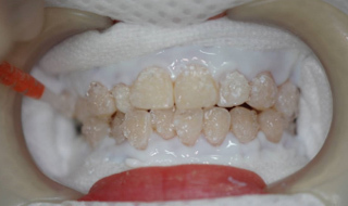 치아 미백제